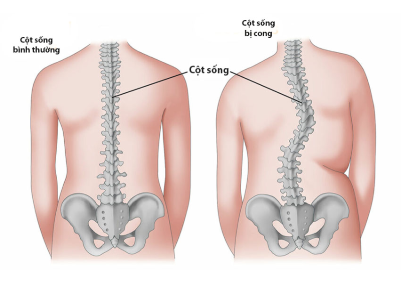 Hình minh họa cấu trúc cột sống và đĩa đệm bị thoát vị, gây áp lực lên dây thần kinh.