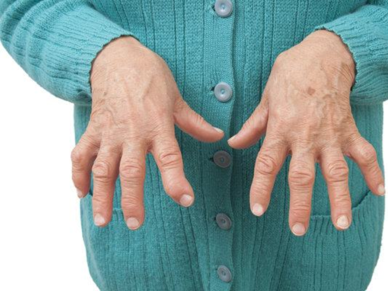 Cứng khớp nếu không điều trị có thể dẫn tới teo cơ, biến dạng khớp và tàn phế.