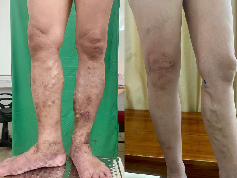 Biến chứng suy giãn tĩnh mạch chi dưới như phù, đau và loét
