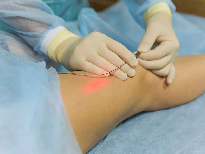 Các phương pháp điều trị suy giãn tĩnh mạch