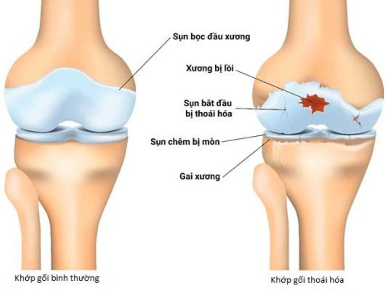 Các phương pháp điều trị thoái hóa khớp gối hiện nay