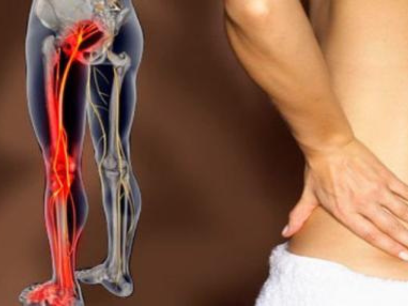 Ngồi lâu hoặc vác nặng gây đau thần kinh tọa